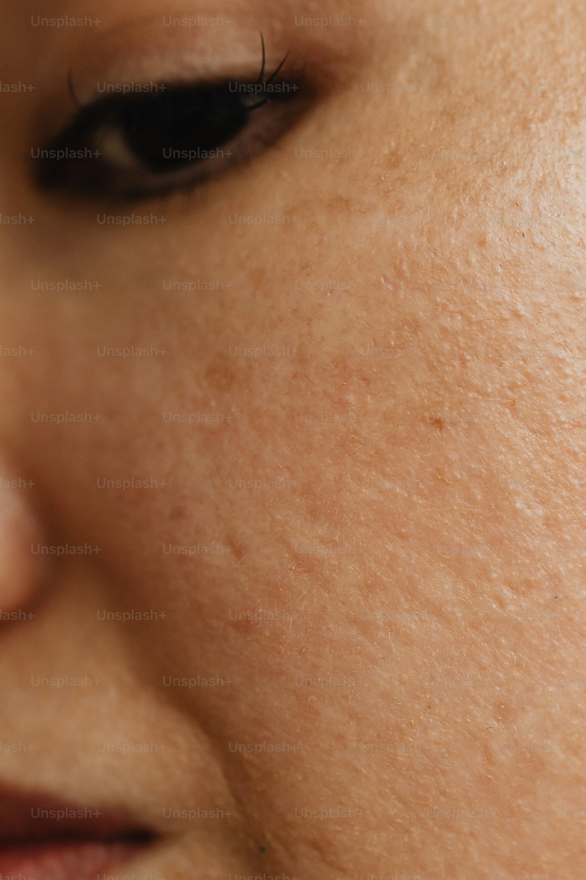 Uneven skin texture treatment